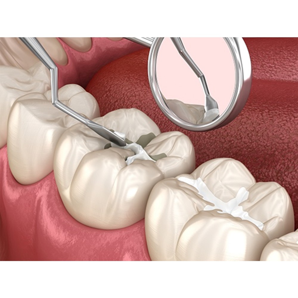 Dental Glass Ionomer Cement for Fixing of Crown & Bridges PL Set ( Without Box )