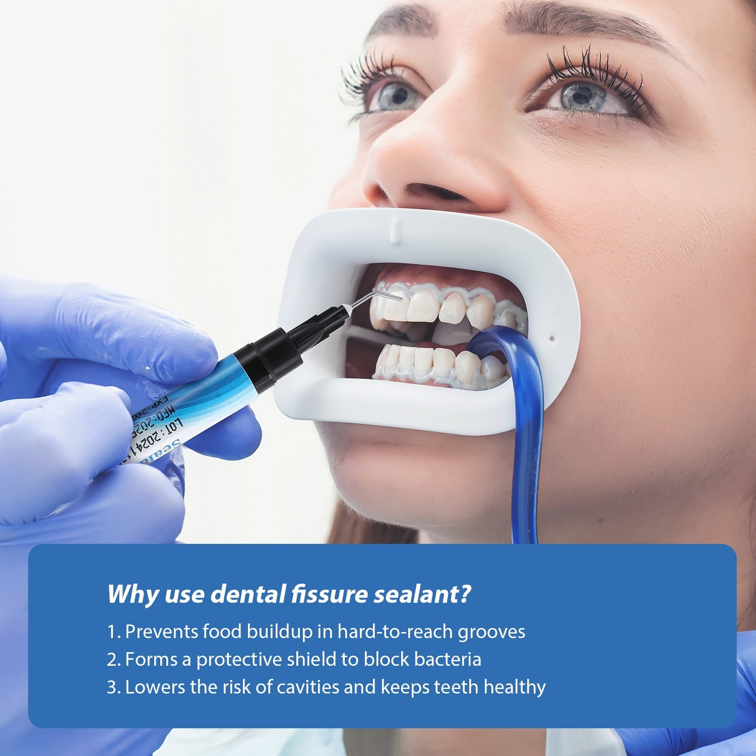 Dental Light Cure Pit Fissure Sealant Resin Fluoride Release for Kids and Adult