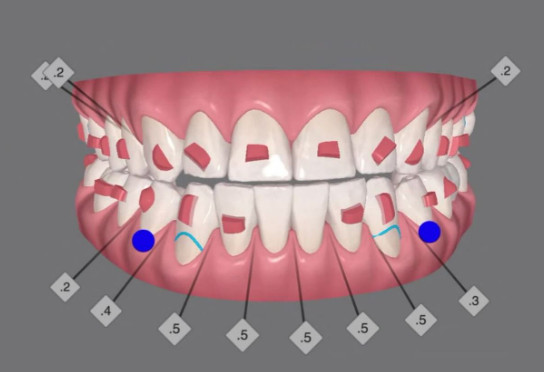 Clincheck, Orthodontic 3D Prediction. Printed layout or Cheek retractor.