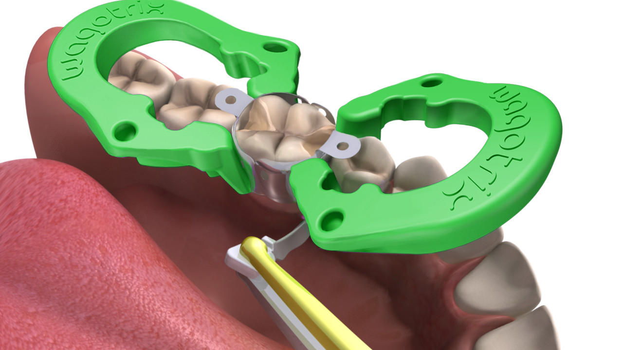 Sectional Matrix System Dental – Wagotrix Intro Kit, Matrix Ring, Wedge, Matrix