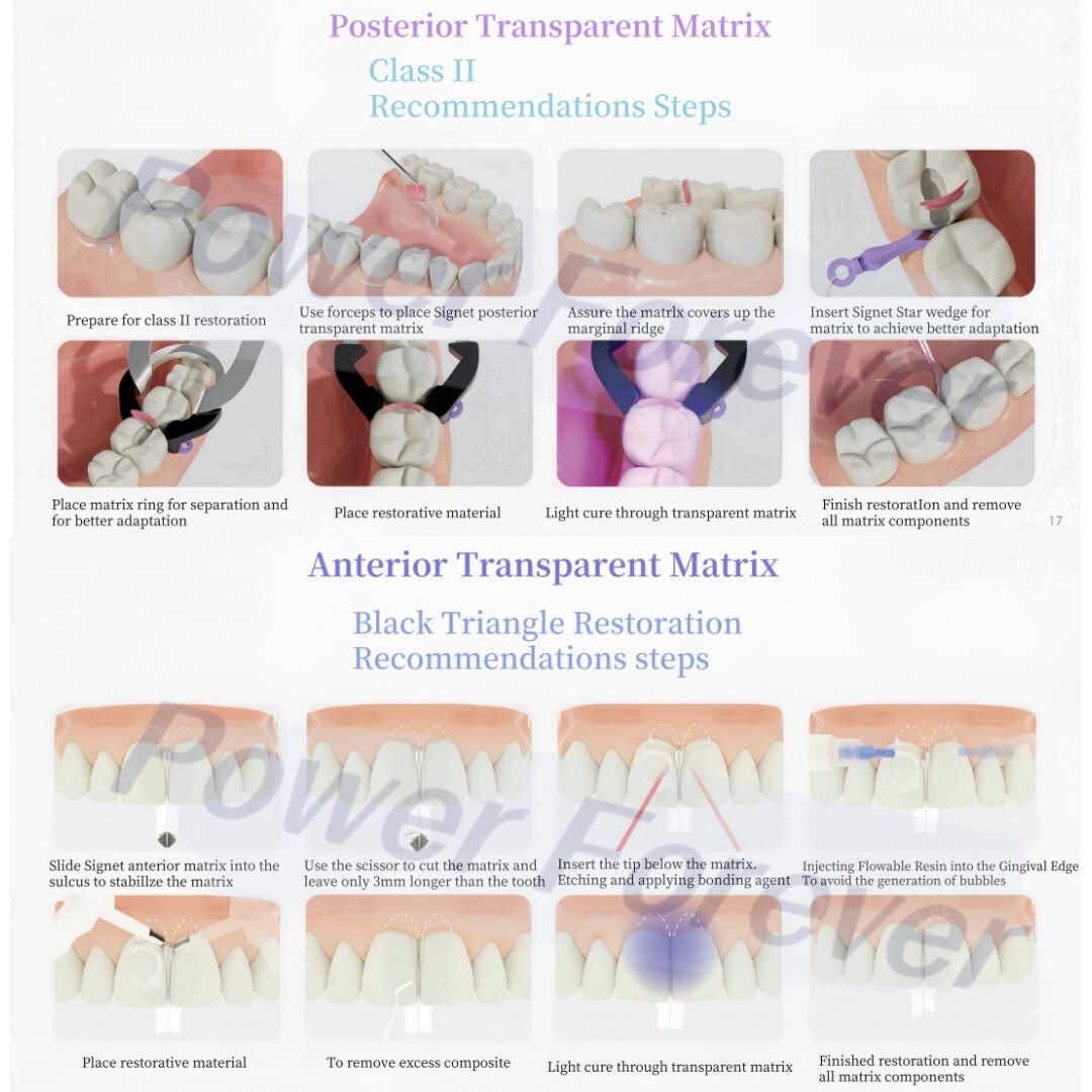 Dental Clear Matrix Anterior Posterior Restorative BT Bow Matrices Fit BioClear